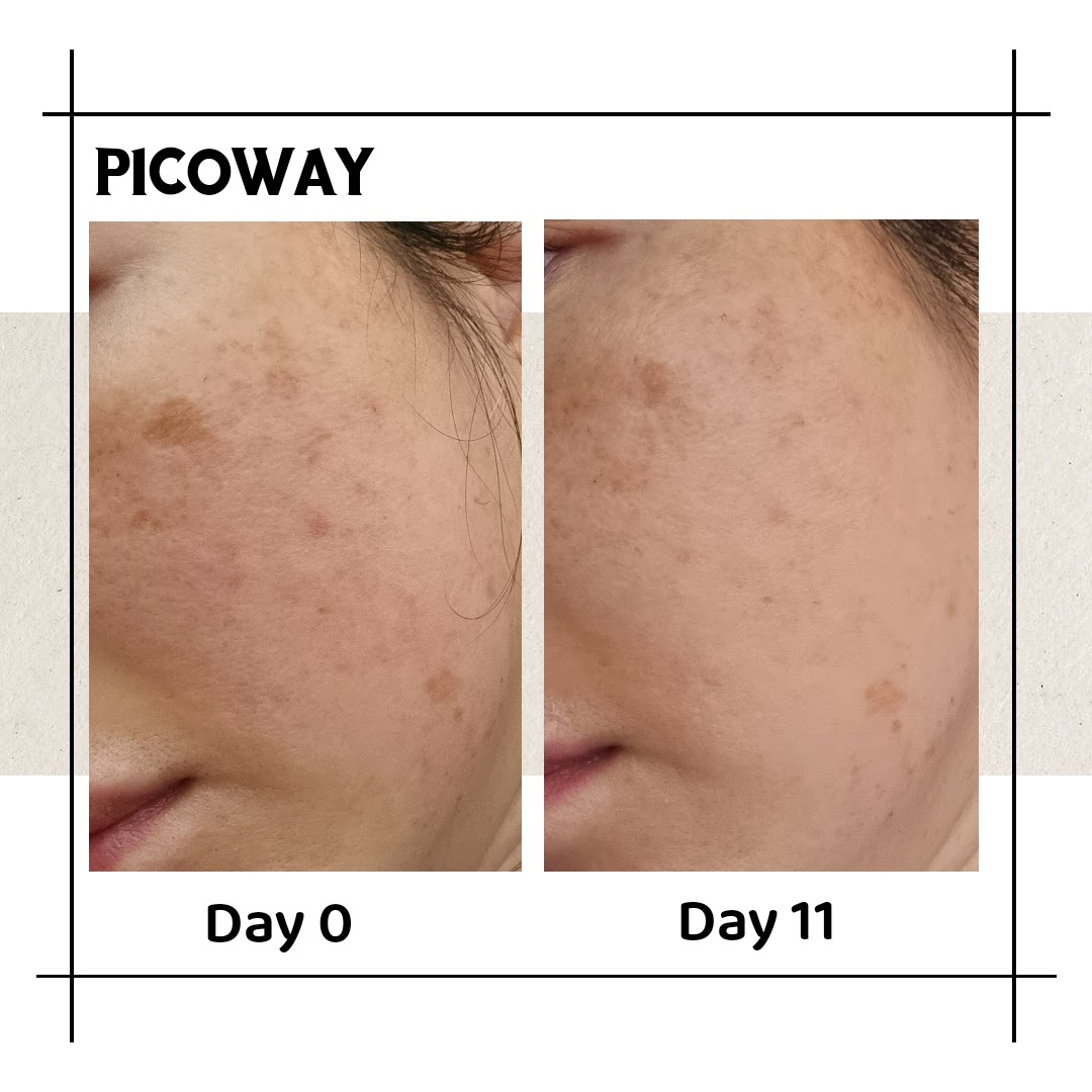 Piccoway results on pigmentation (Asian skin)